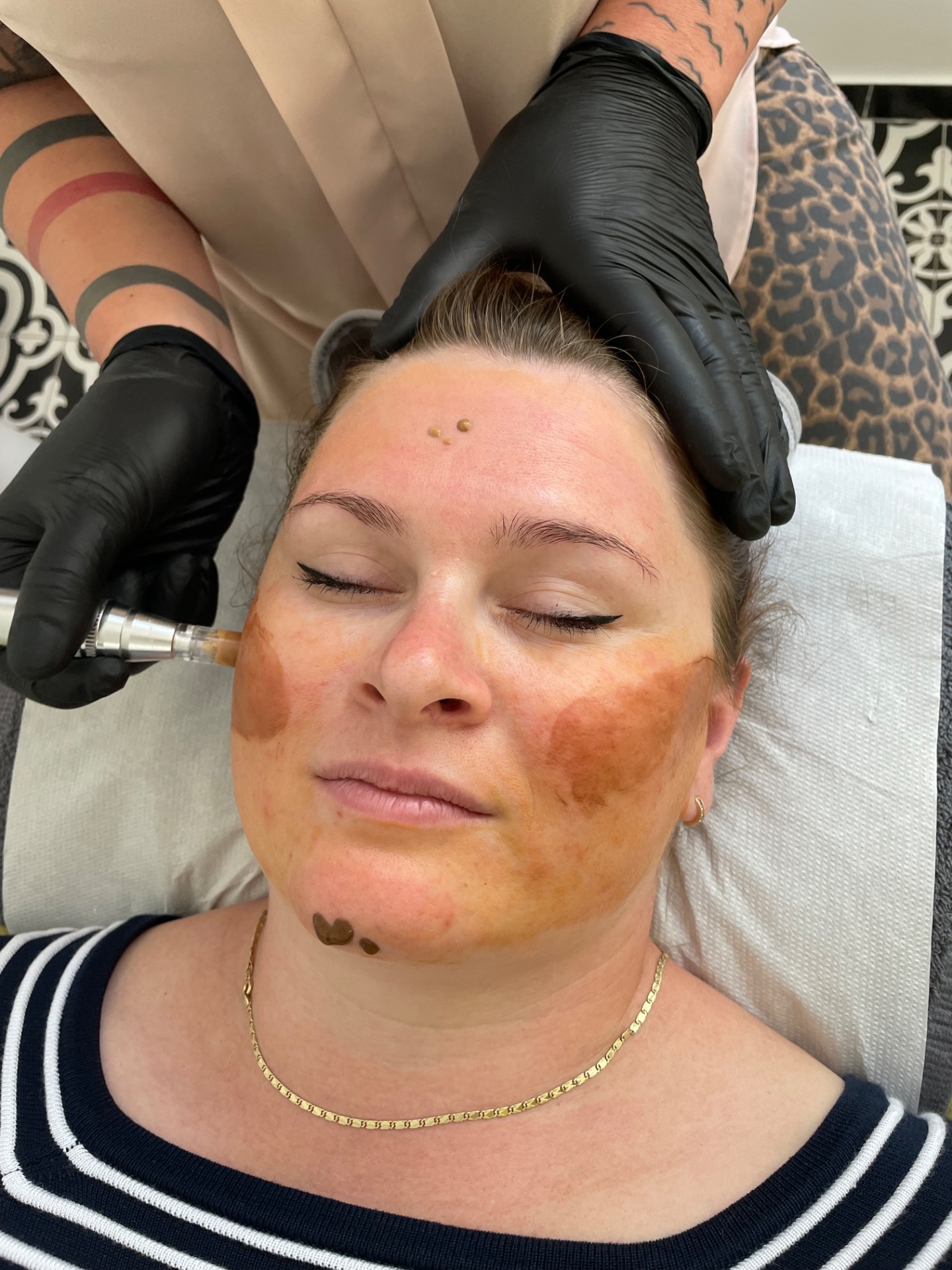 MIKROJEHLIČKOVÁNÍ S BB GLOW